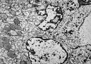 F, 73y. | follicular carcinoma of thyroid gland F, 73y. | follicular carcinoma of thyroid gland